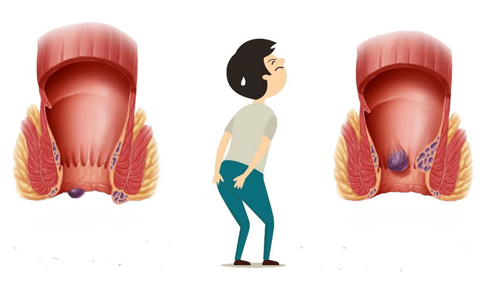 Symptome von Hämorrhoiden